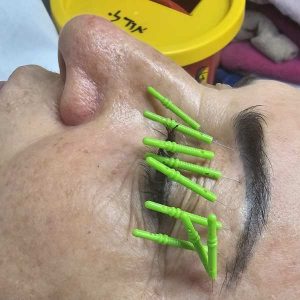 דיקור בעפעפים כטיפול קוסטמטי