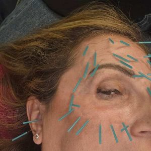 דיקור בכל הפנים כטיפול קוסטמטי