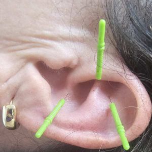 דיקור באוזנים כטיפול קוסטמטי