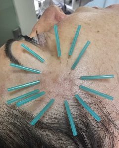 דיקור בלחי כטיפול קוסטמטי