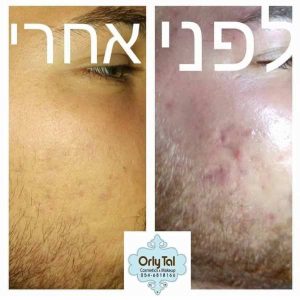 תמונת לפני ואחרי טיפול באקנה