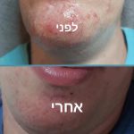 תמונת 2 לפני ואחרי טיפול באקנה
