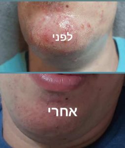 תמונת 2 לפני ואחרי טיפול באקנה